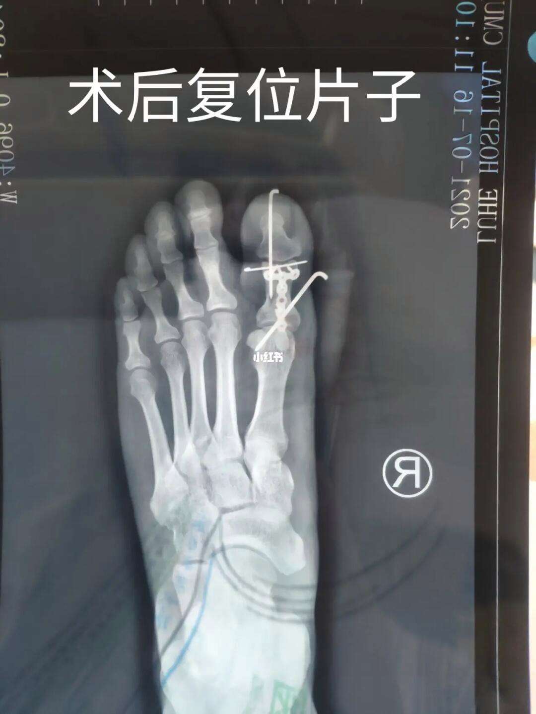 灰熊JJJ正式接受脚趾手术三个月后重新评估